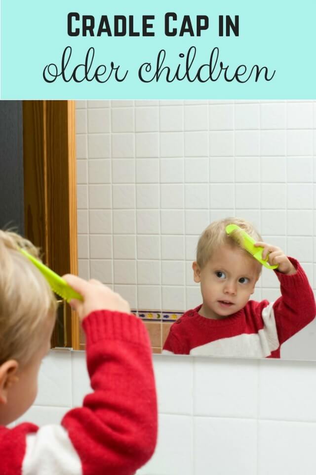 cradle cap in older children - Bubbablue and me